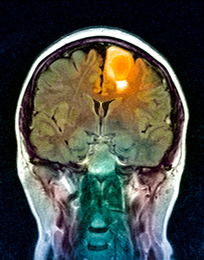 Brain tumour,MRI scan