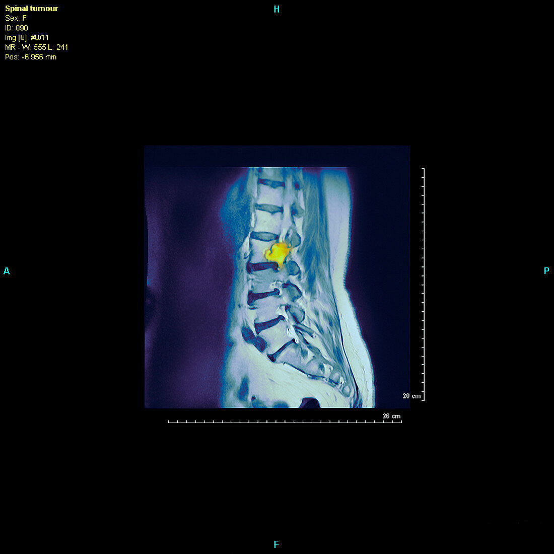 Spine tumour,MRI scan
