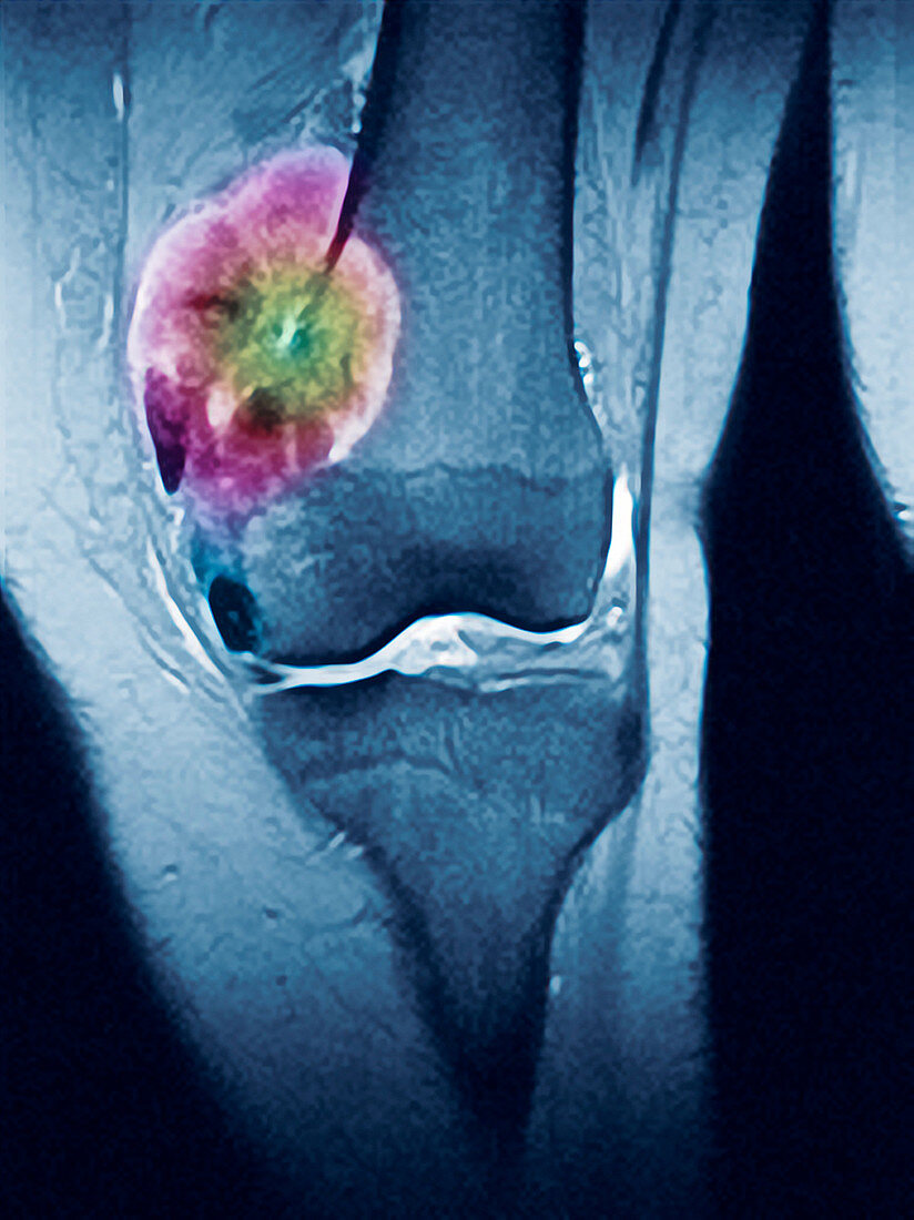 Bone tumour,MRI scan