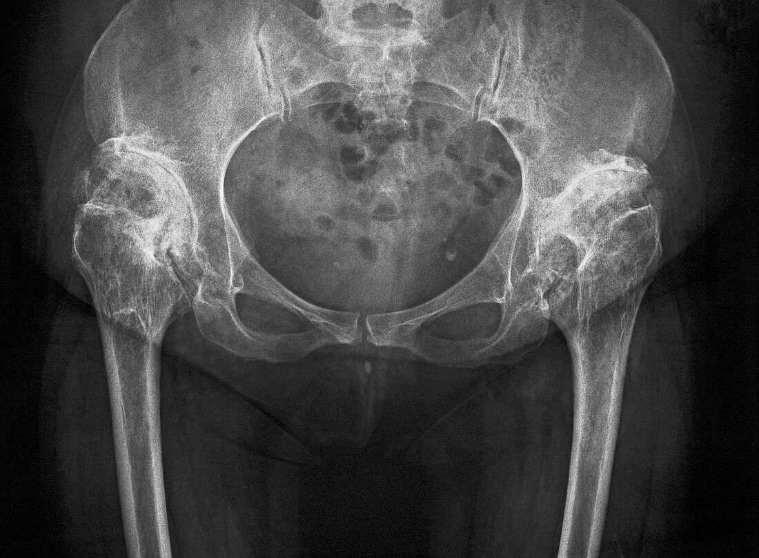 Congenital hip dysplasia,X-ray