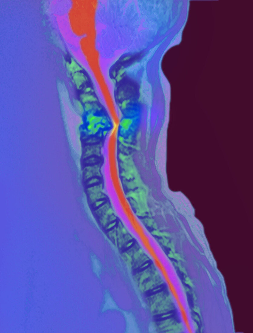 Inflamed spinal discs,MRI scan