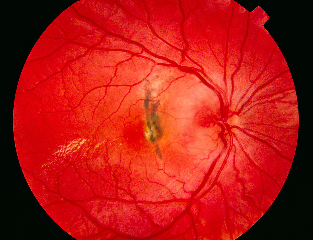 Retina damage from diabetes