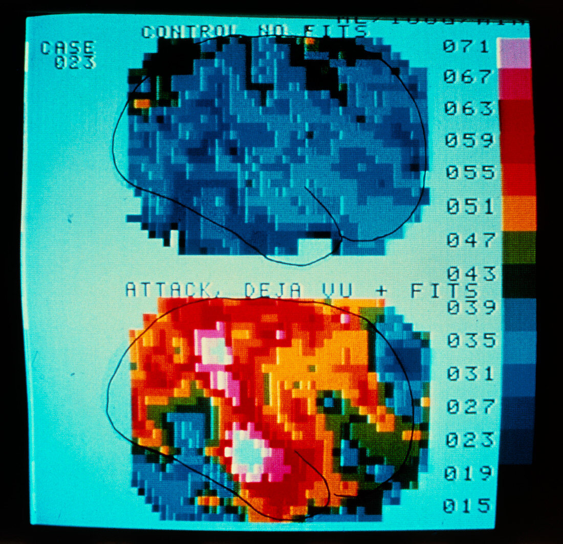 Gamma camera scan of blood flow in the brain