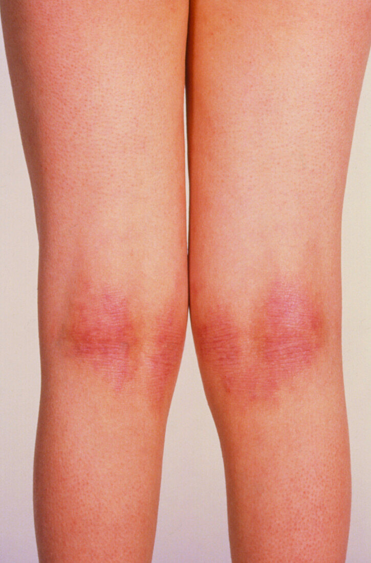 Atopic eczema affecting knees of young woman