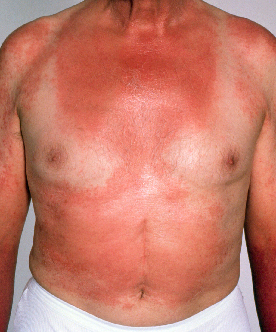 Elderly man suffering from photosensitive eczema