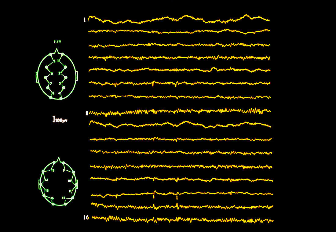 EEG in epilepsy: intermittent focal spikes