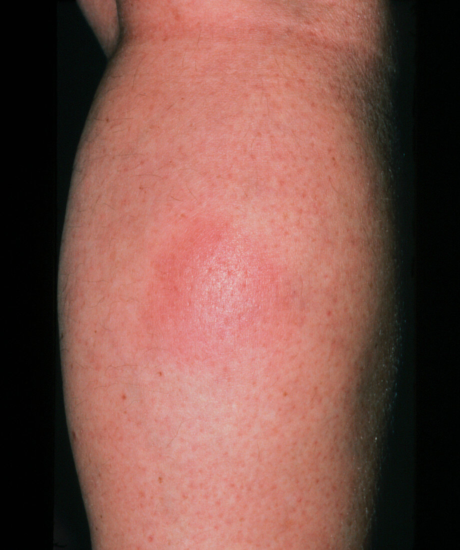 Erythema nodosum on a calf