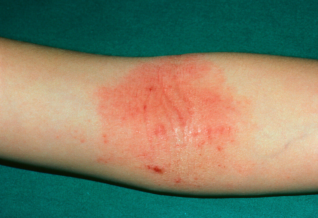 The elbow of a patient affected by atopic eczema
