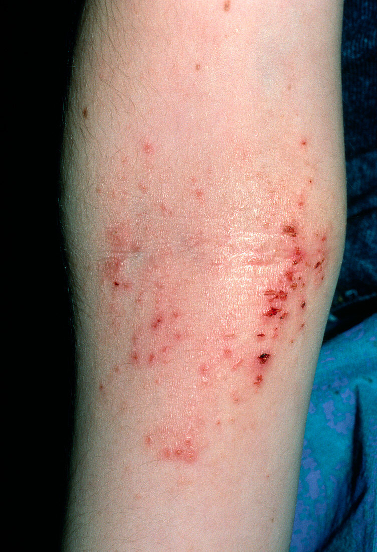 Atopic eczema in crook of the elbow
