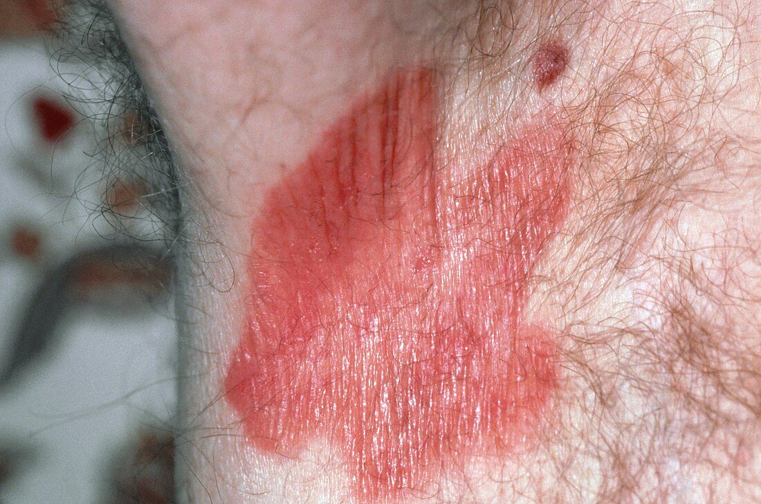 Erythrasma skin infection in man's armpit