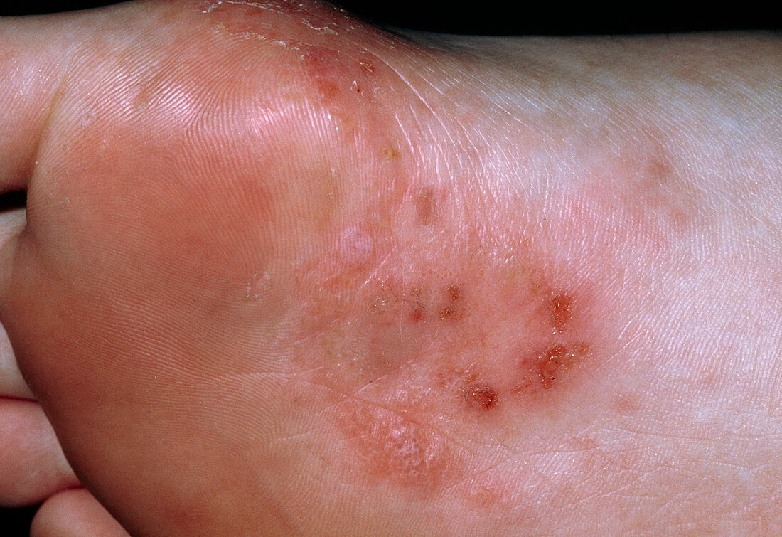 The sole of a foot affected by pompholyx (eczema)