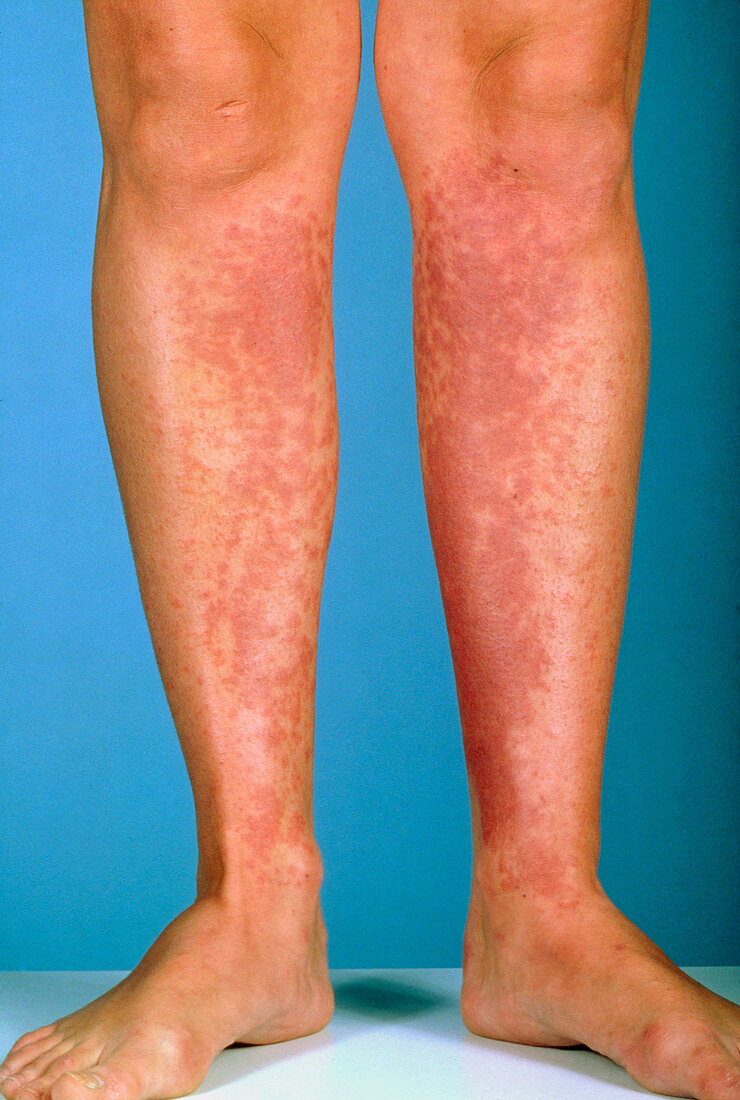 Contact dermatitis to shins due to shaving foam