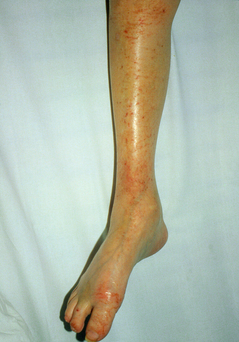 Leg affected by dermatitis herpetiformis