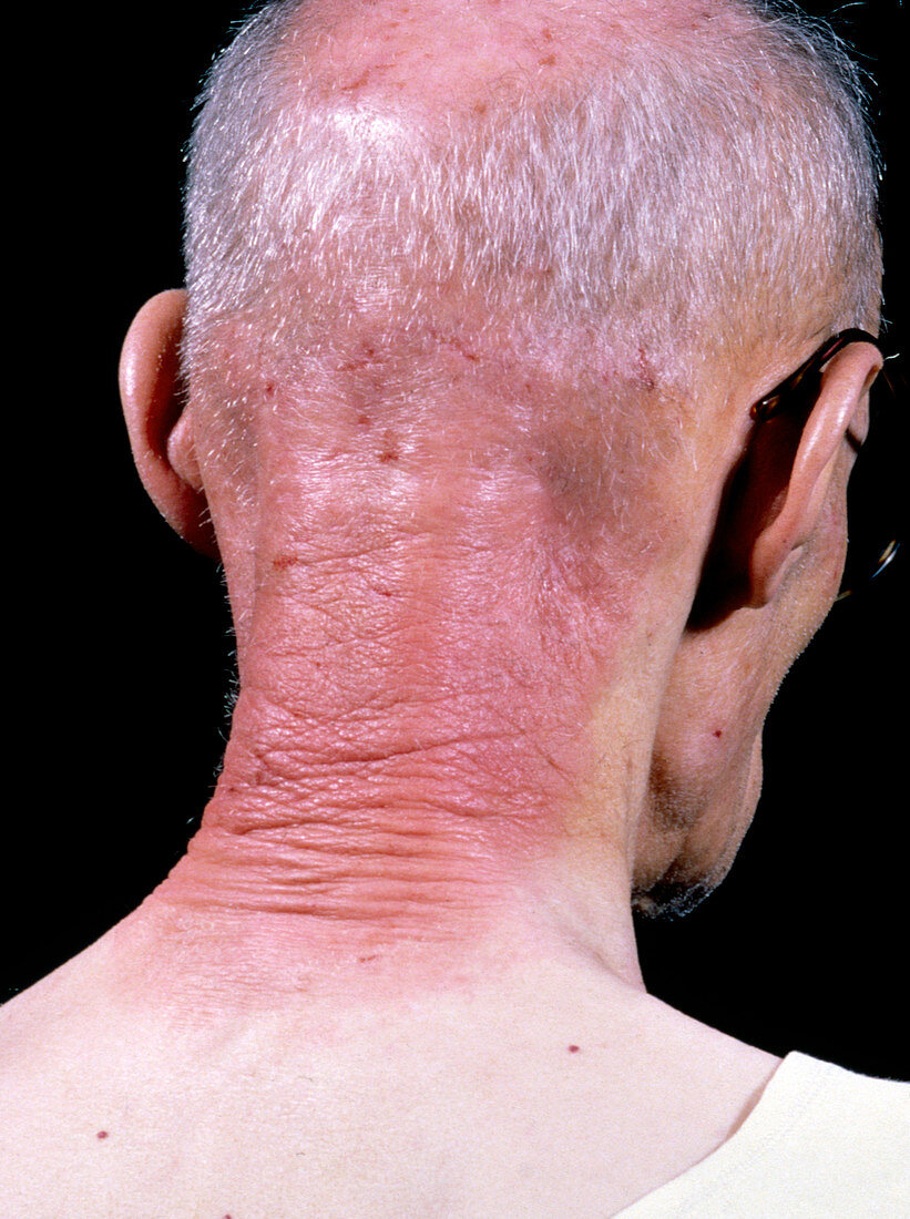Skin dermatitis