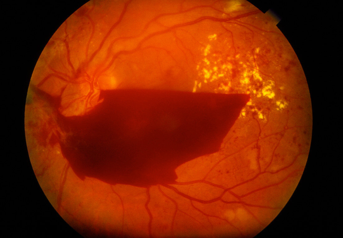 Diabetic retinopathy: sub-hyaloid haemorrhage