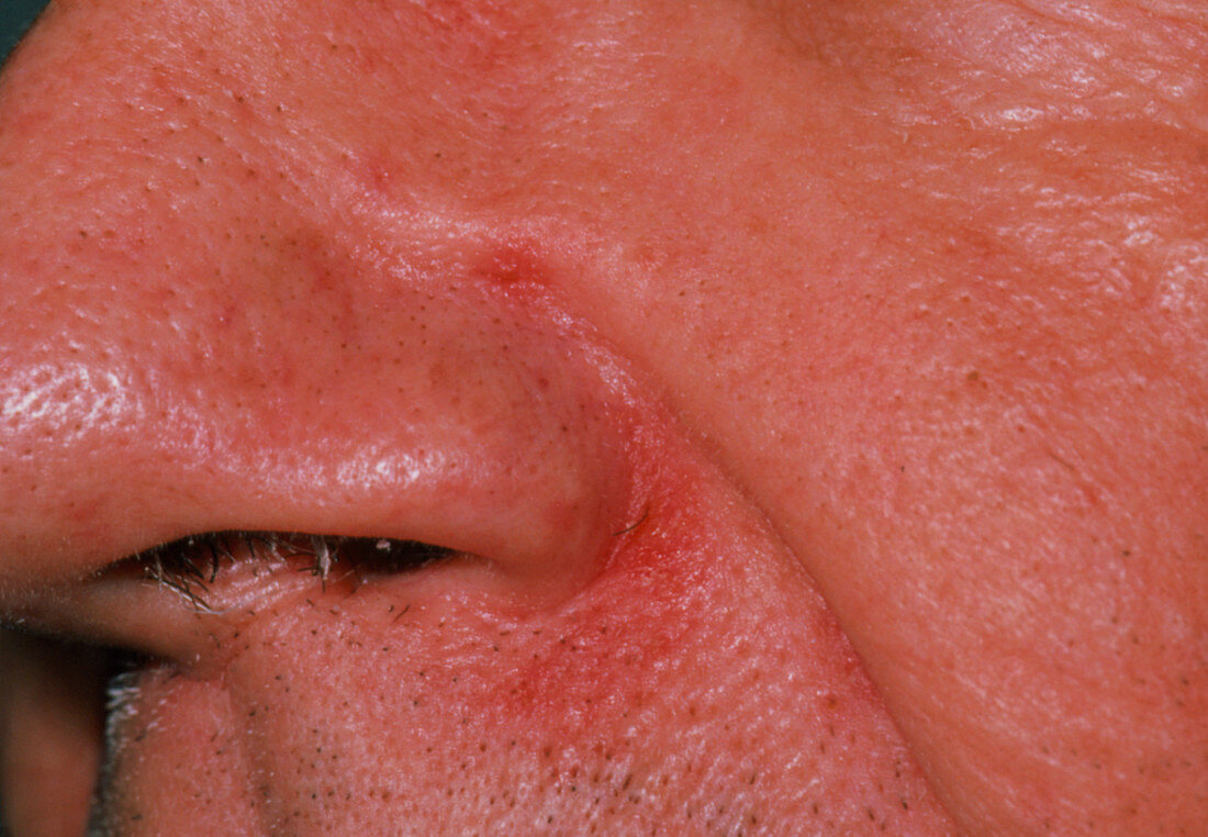 Patient with seborrhoeic dermatitis