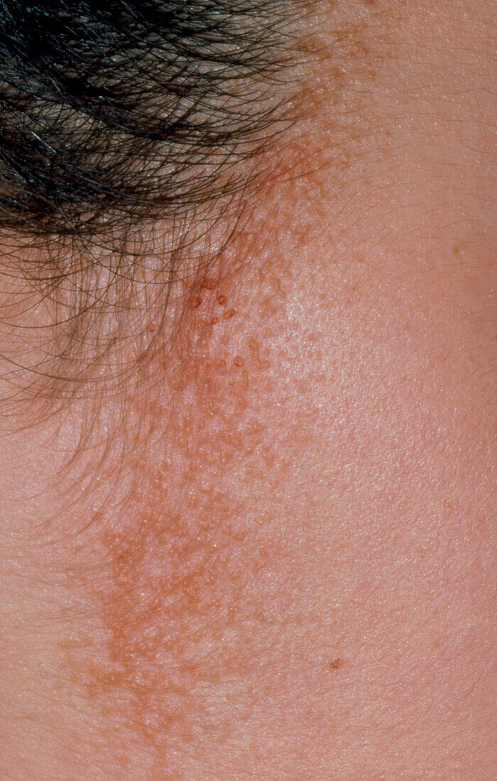 Seborrhoeic dermatitis around hairline