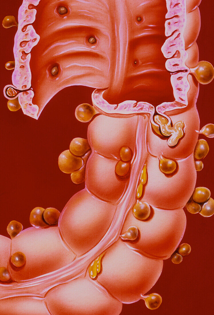 Illustration of colon diverticulitis