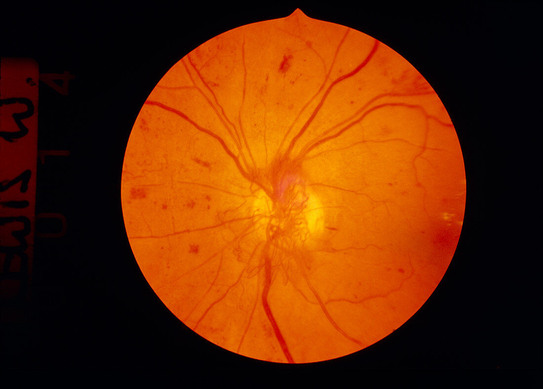 Ophthalmoscopy of eye with diabetic retinopathy
