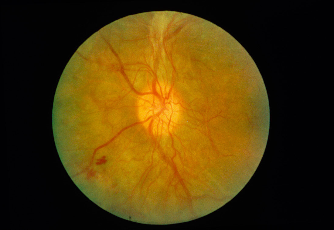 Ophthalmoscopy of diabetic retinopathy after laser