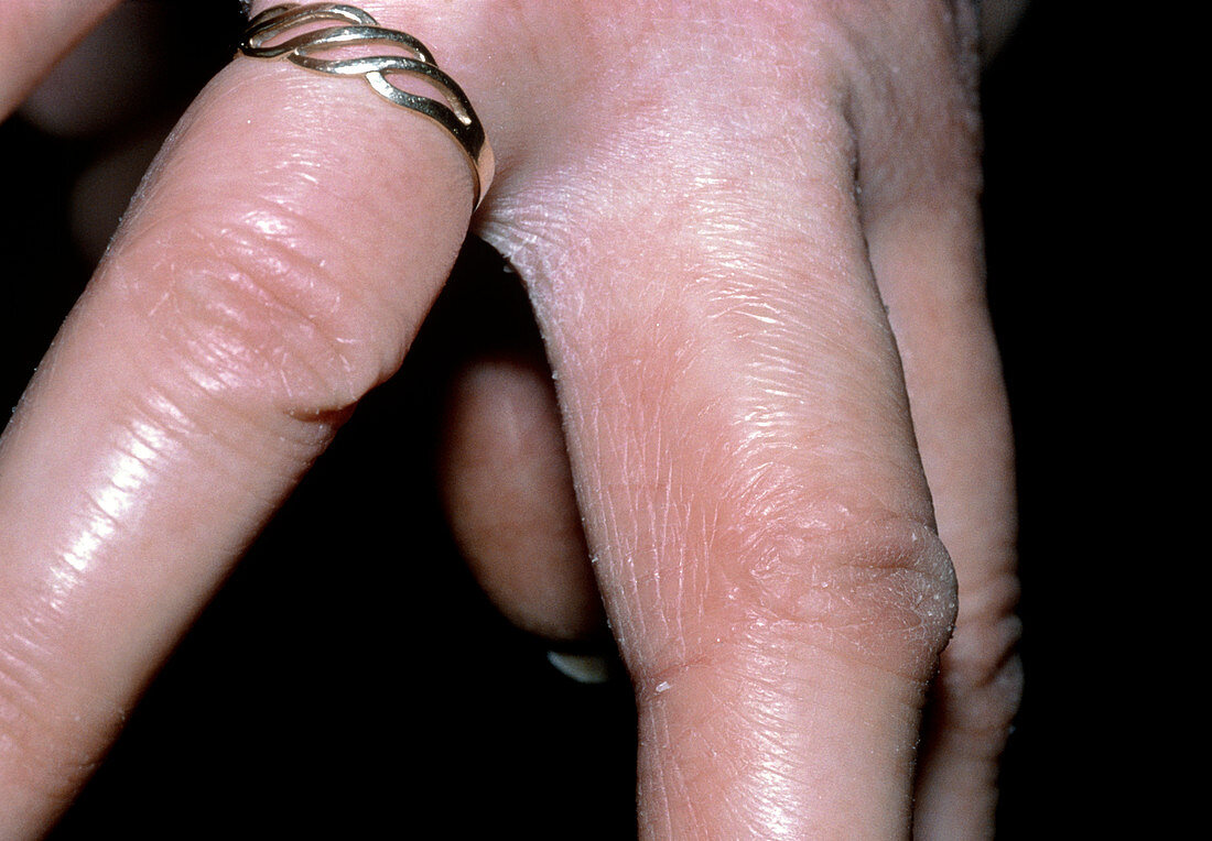 Dermatitis of hands caused by washing up liquid