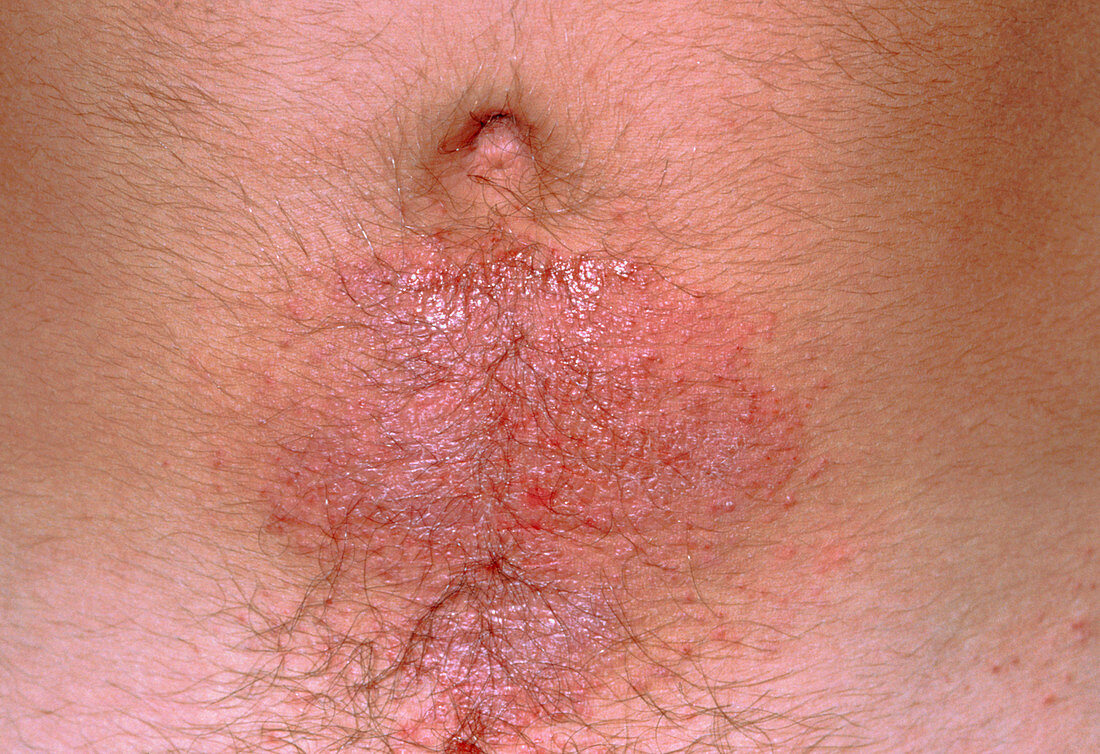 Contact dermatitis on stomach due to belt buckle
