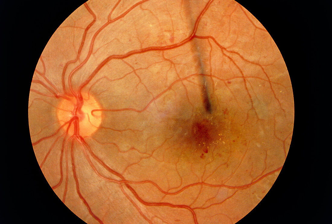 Ophthalmoscopy of maculopathy in diabetic's eye