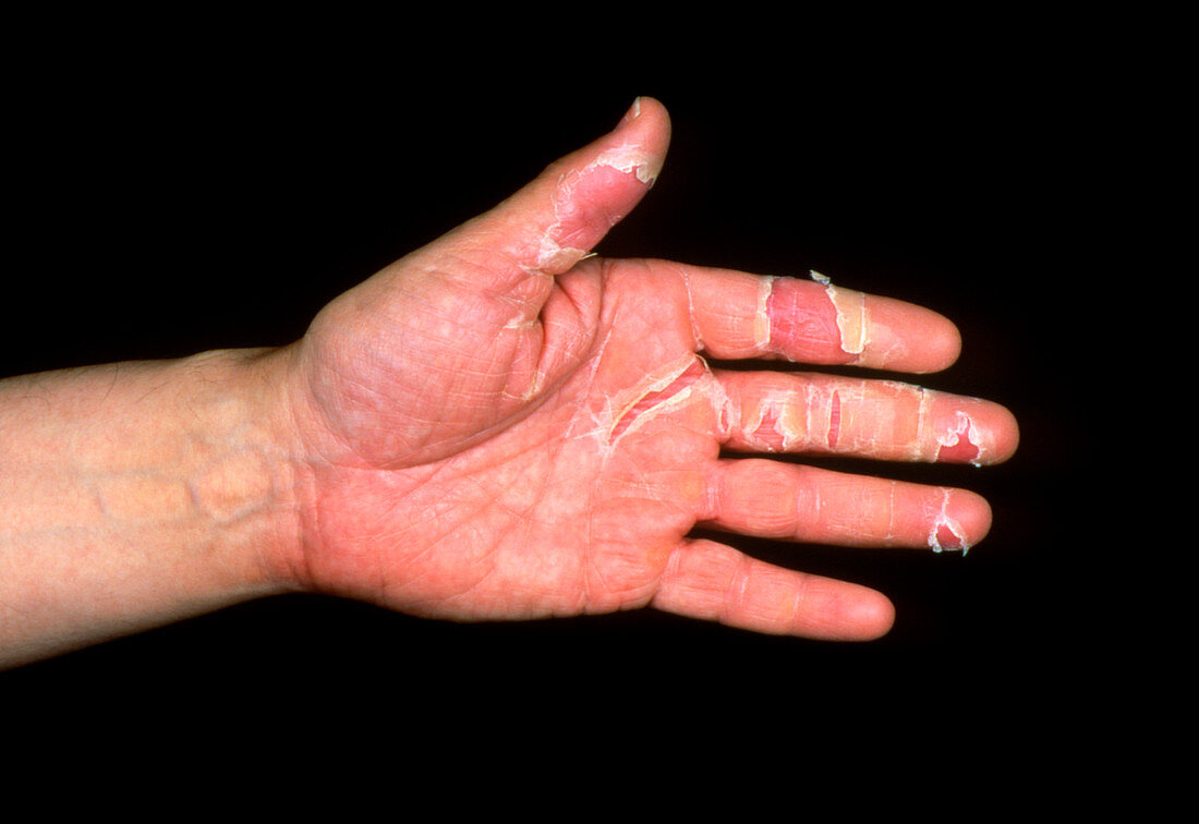 Dermatitis on a man's hand due to stress