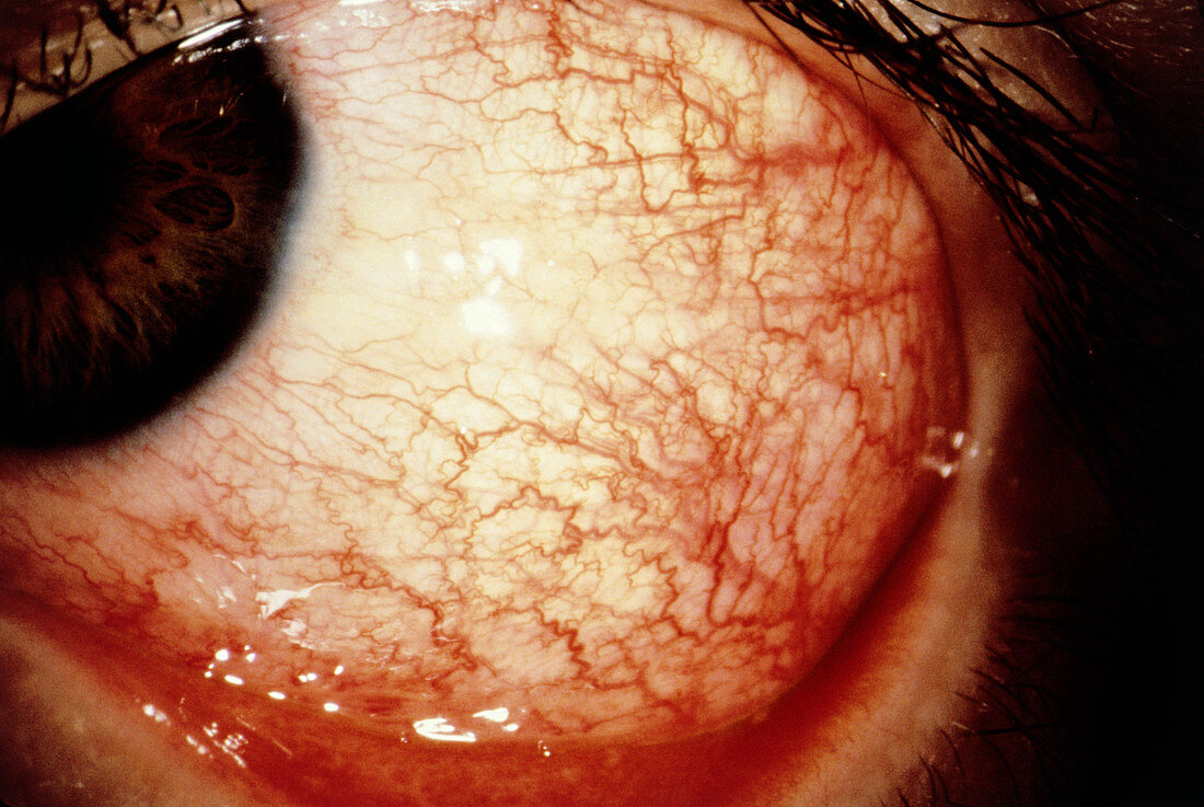 Close up of conjunctivitis in the eye