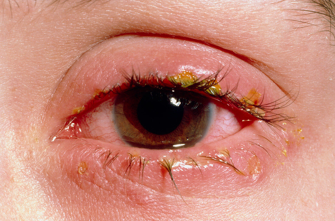 Blepharitis,inflammation of eyelids