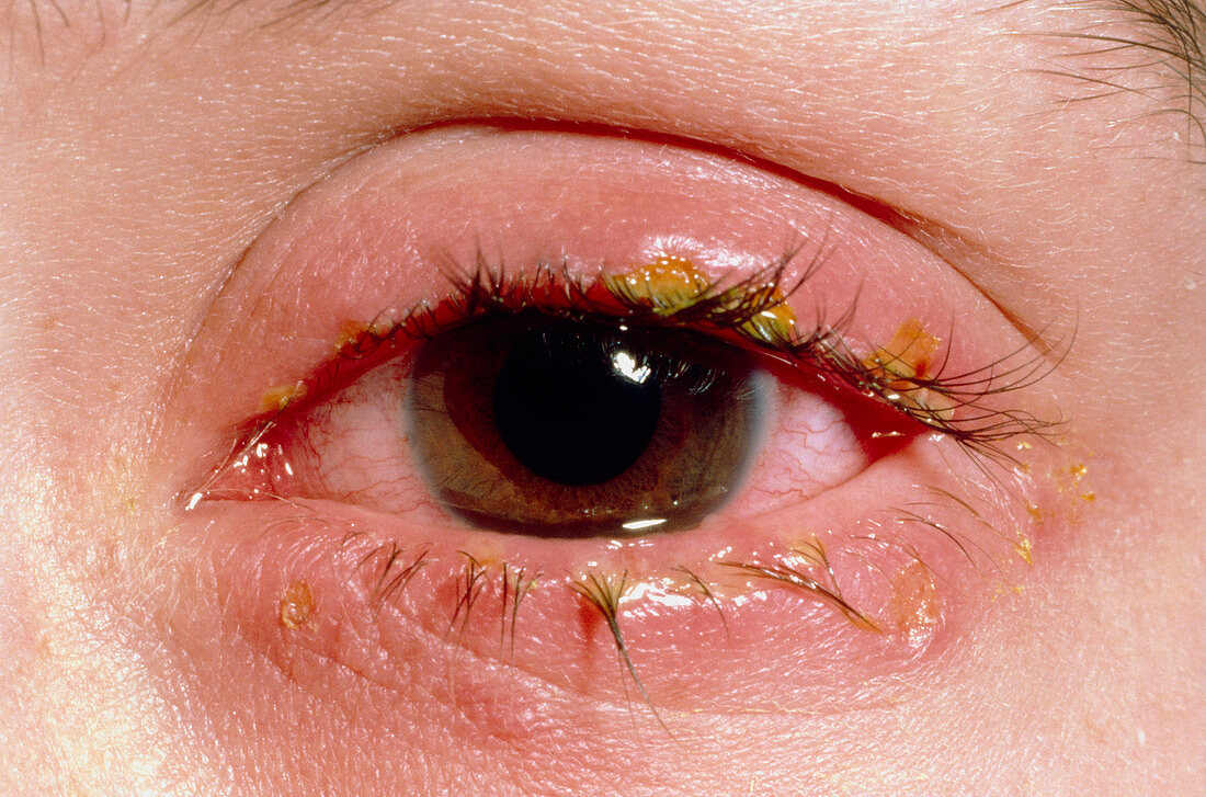 Blepharitis Inflammation Of Eyelids Bild Kaufen 11838866 Science