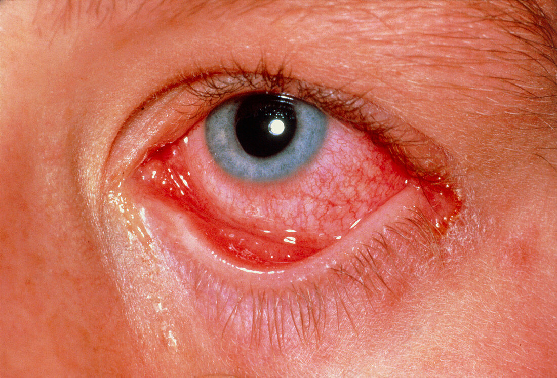Conjunctivitis (conventional photo of eye)