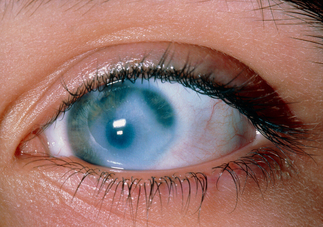 Congenital glaucoma in teenage girl