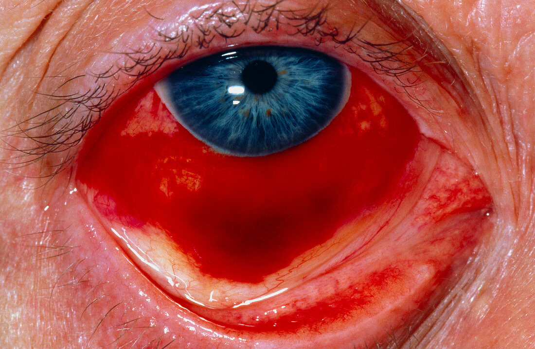 Close-up of eye showing conjunctival haemorrhage