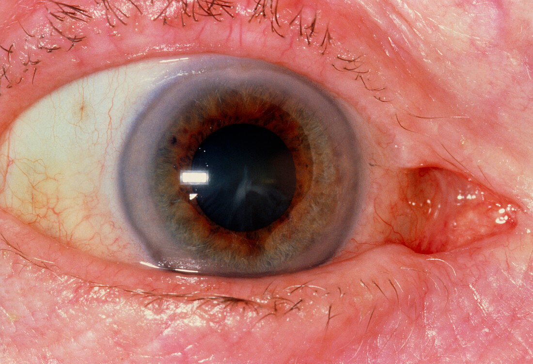 Close-up of an eye affected by cataract
