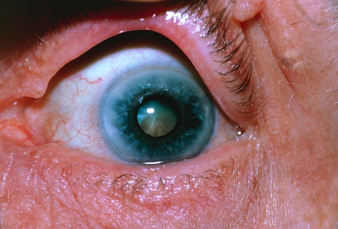 Eye disorders: arcus senilis and cataract