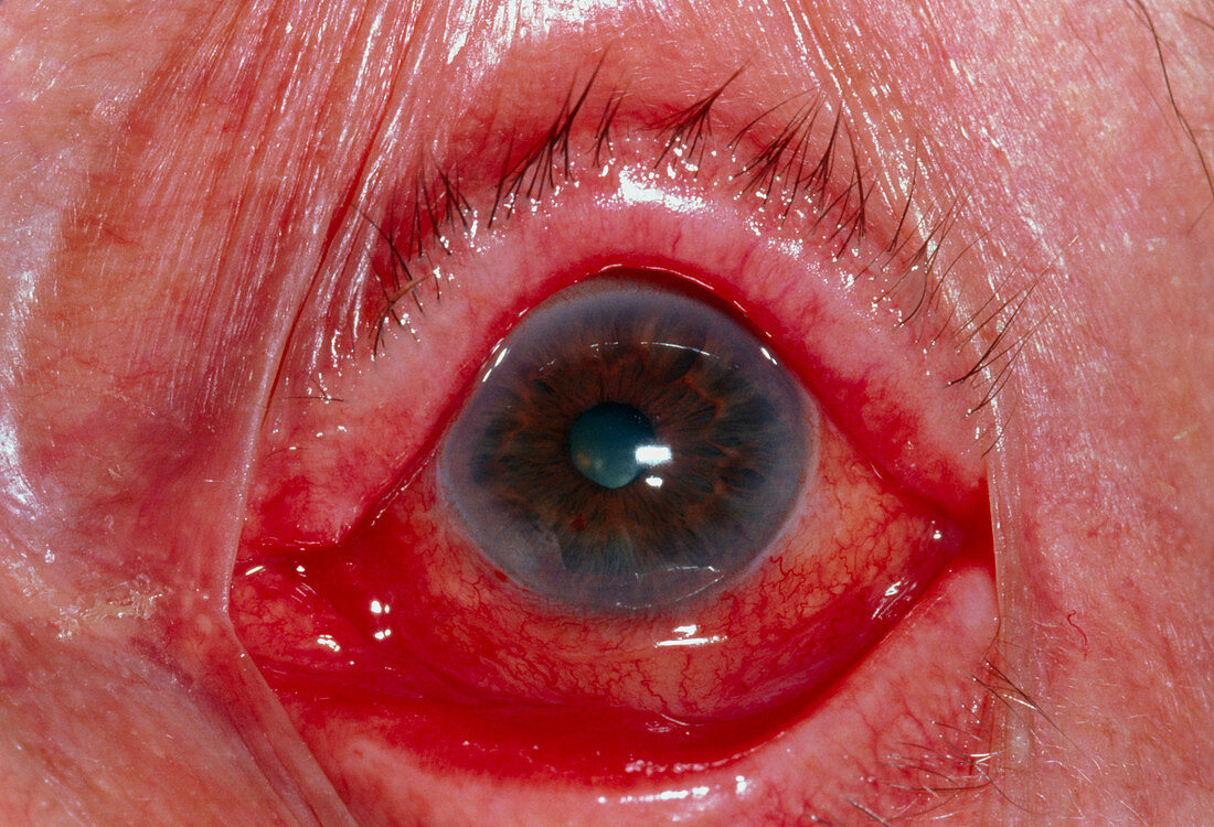 Close-up of an eye affected by keratitis