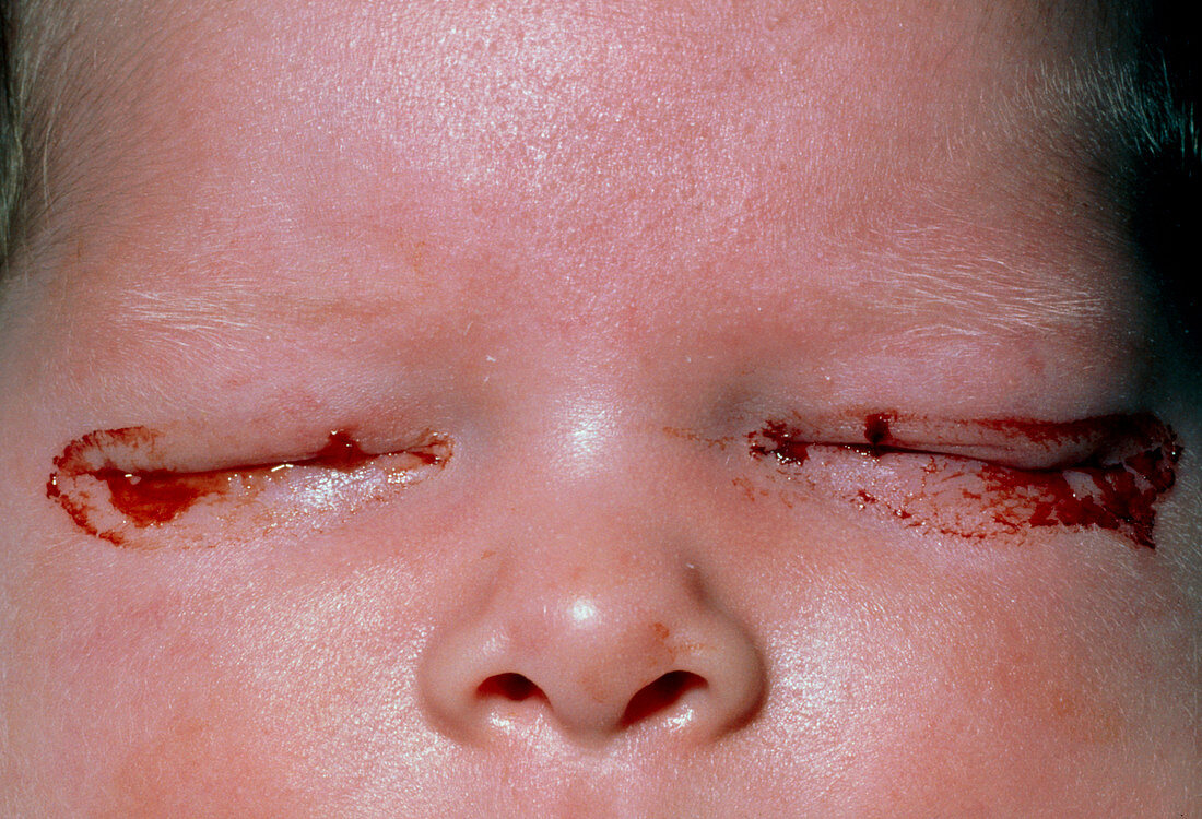 Neonatal chlamydial conjunctivitis