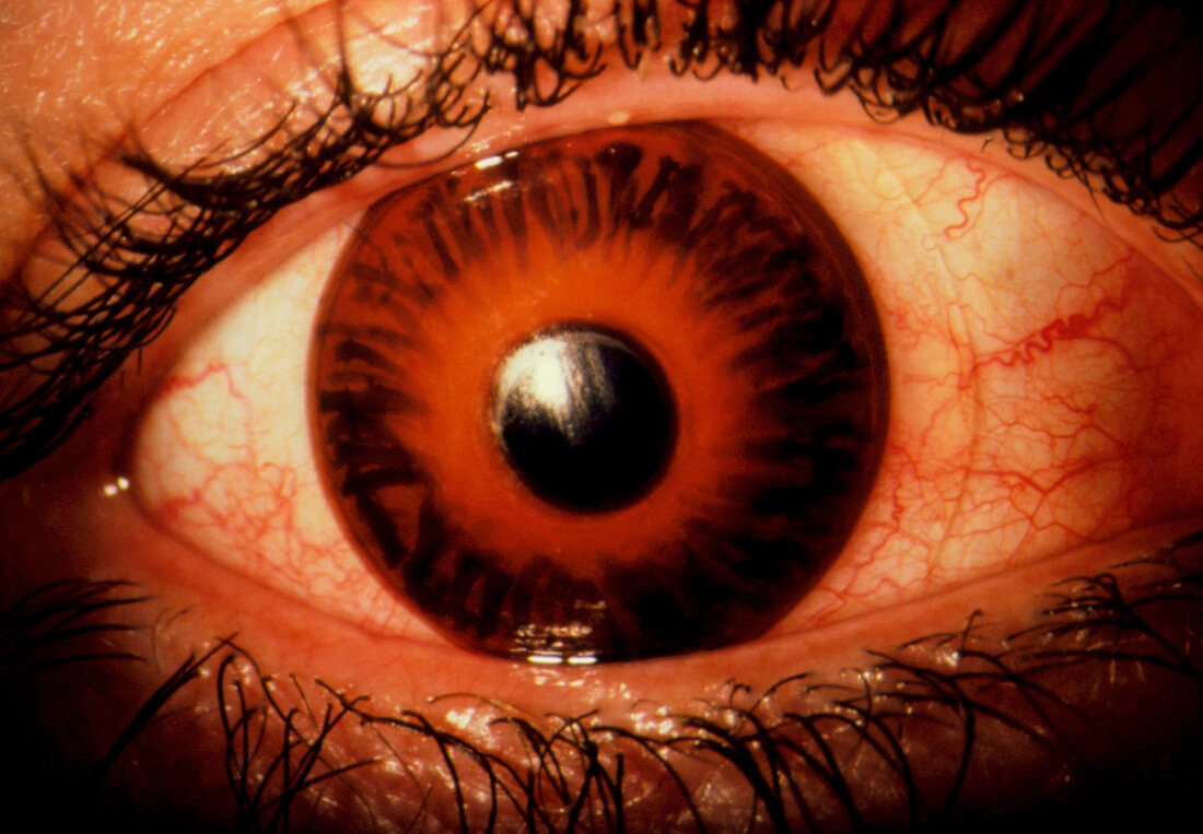 Glaucoma: swollen inflamed eye with contact lens