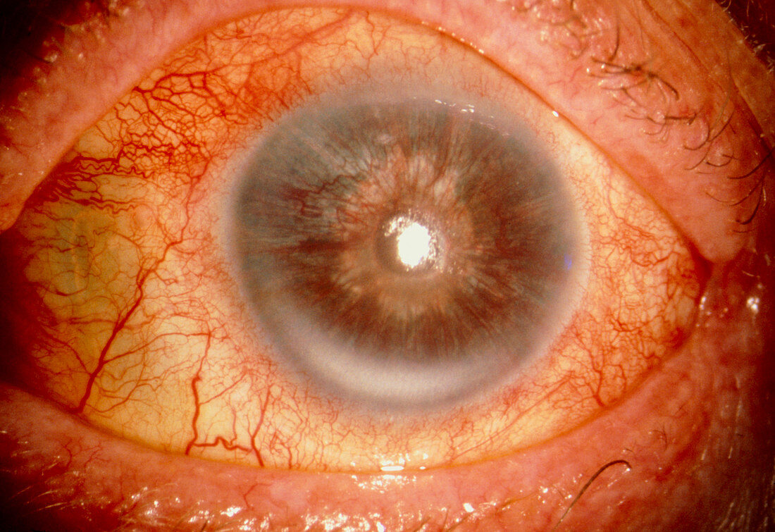 Rubeotic glaucoma: rubeotic glaucoma