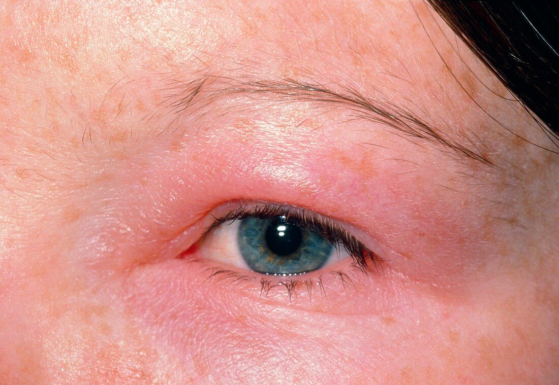 Periorbital oedema of eye due to dog allergy