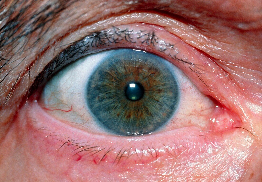 Eye following glaucoma therapy,using pilocarpine