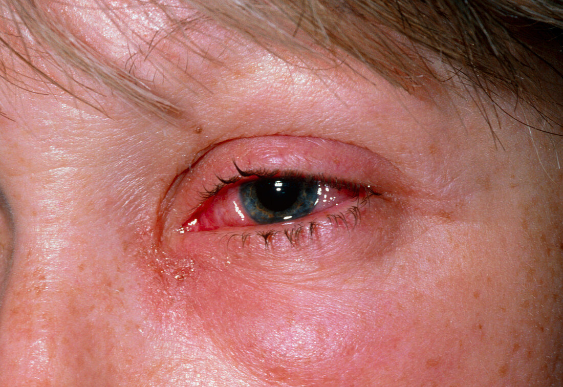 Viral conjunctivitis in the eye of a woman