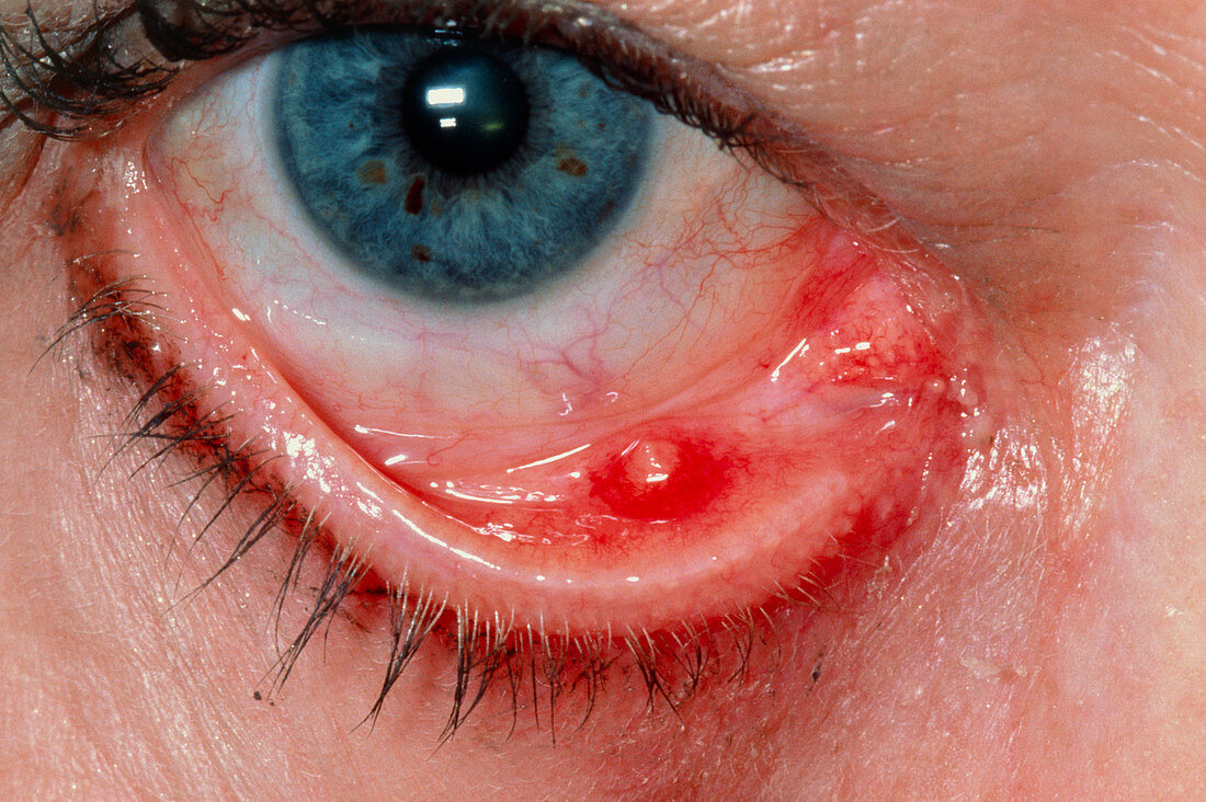 Meibomian cyst (chalazion) on lower eyelid