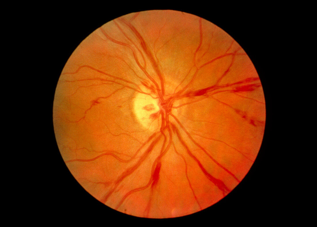 Ophthalmoscopy of eye showing retinal vasculitis