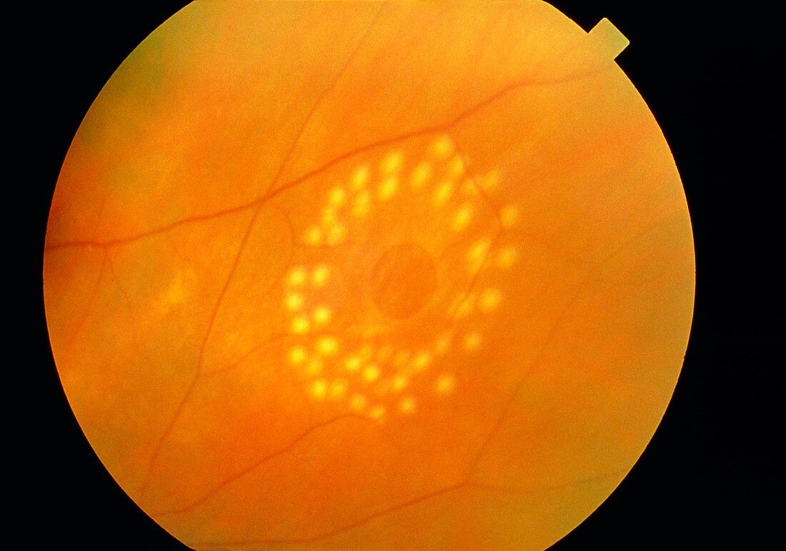 Ophthalmoscope view of laser-treated retinal hole
