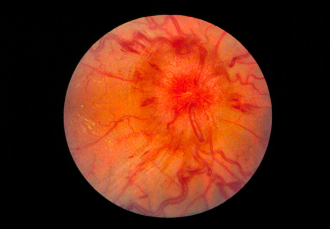 Ophthalmoscope view of retina showing papilloedema
