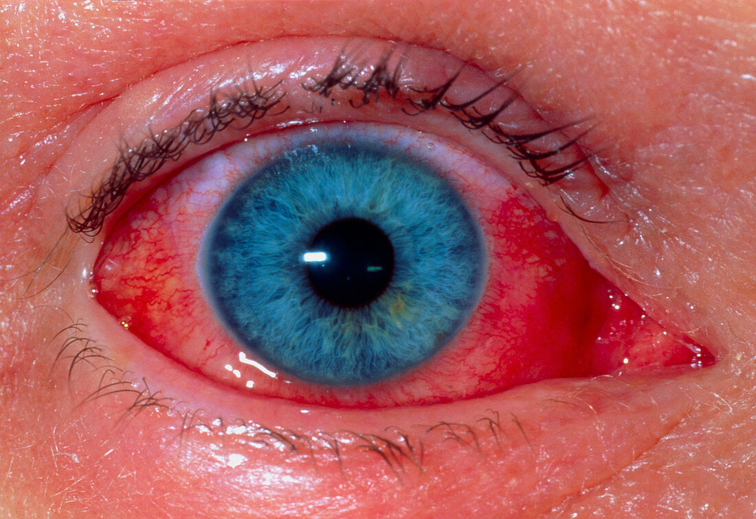 Allergic conjunctivitis due to contact lens