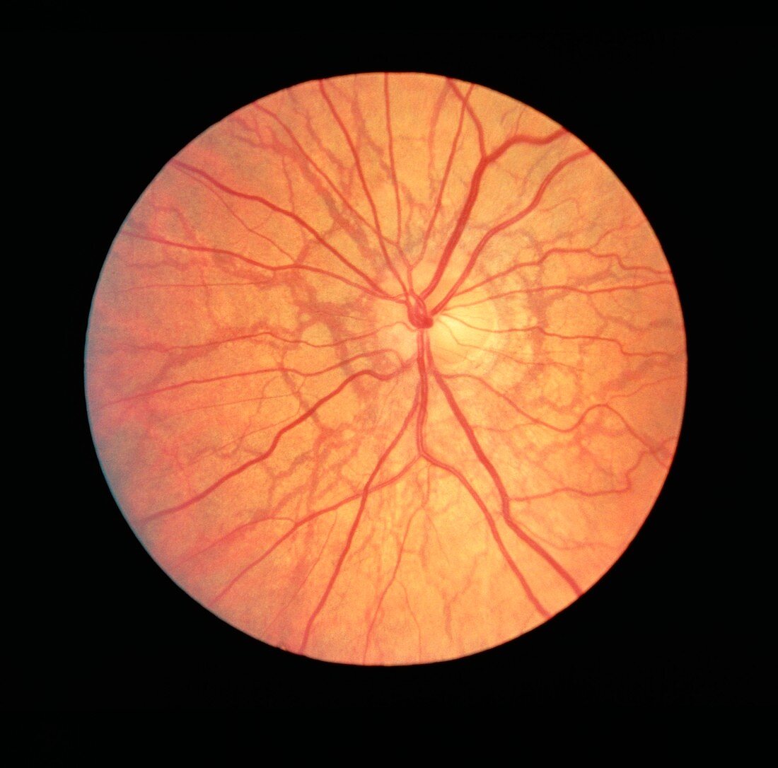 Ophthalmoscope view of retina with angioid streaks
