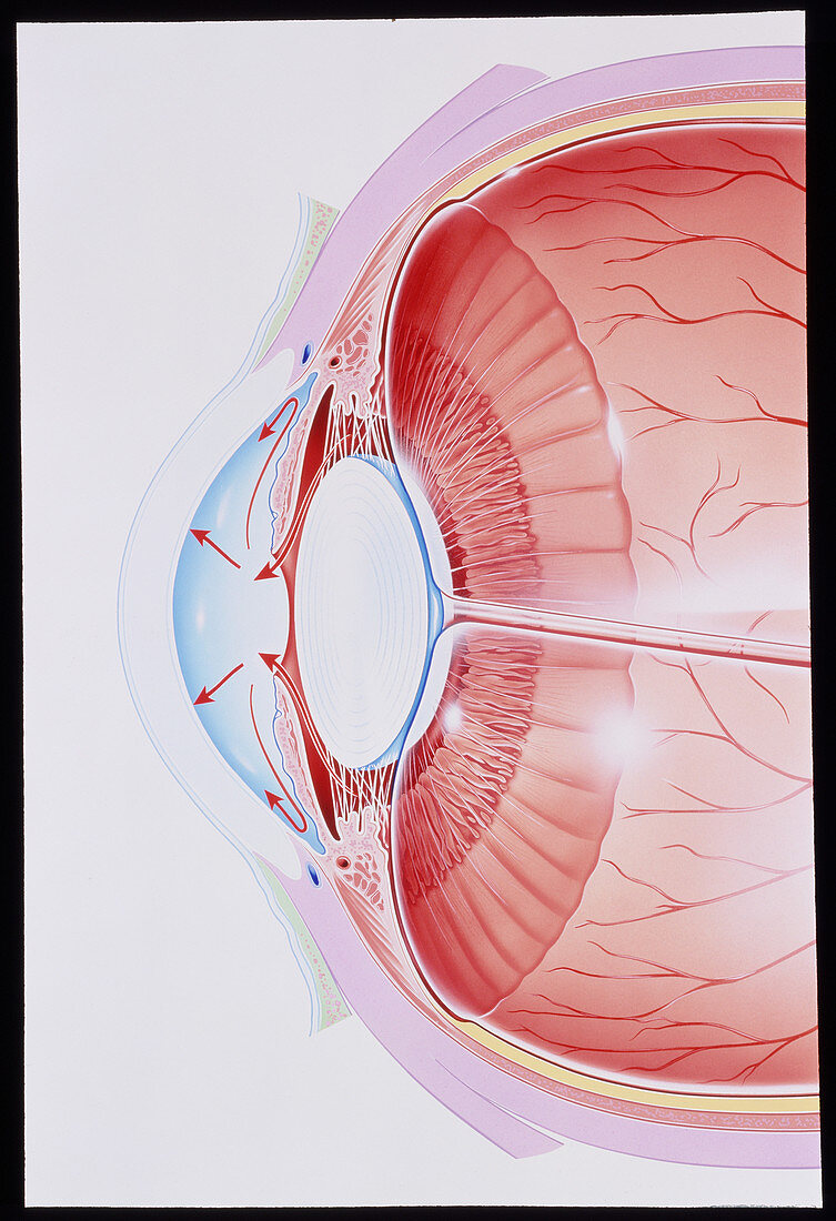 Artwork showing glaucoma,eye in cross section
